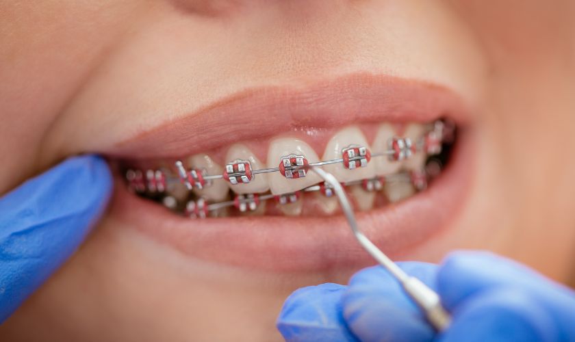 Braces-In-Bateman-Orthodontics
