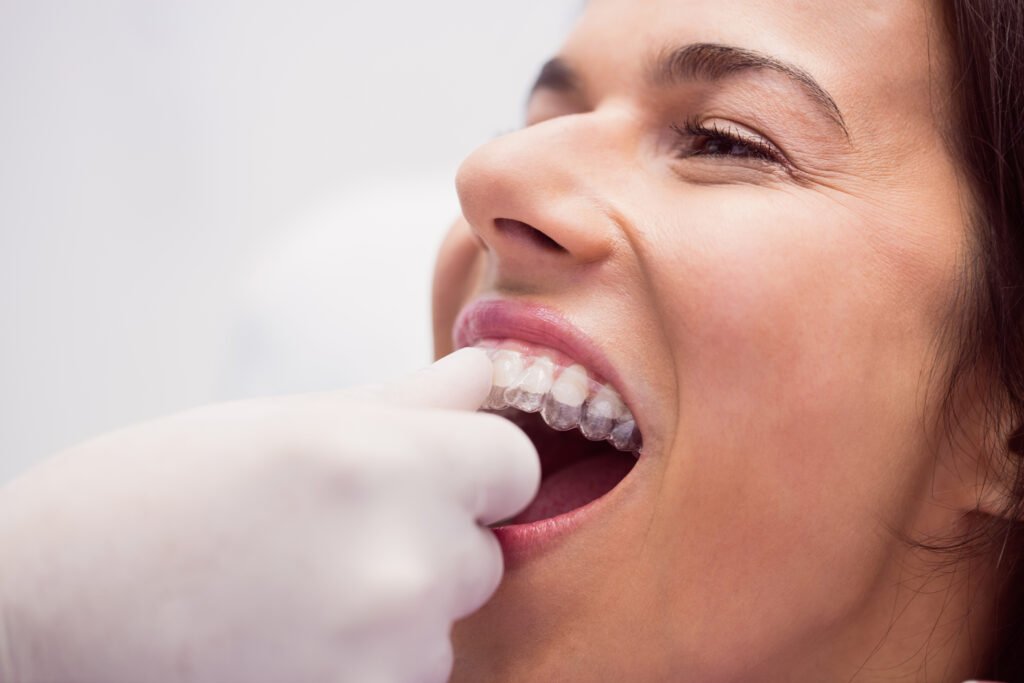 Invisalign in Rochester