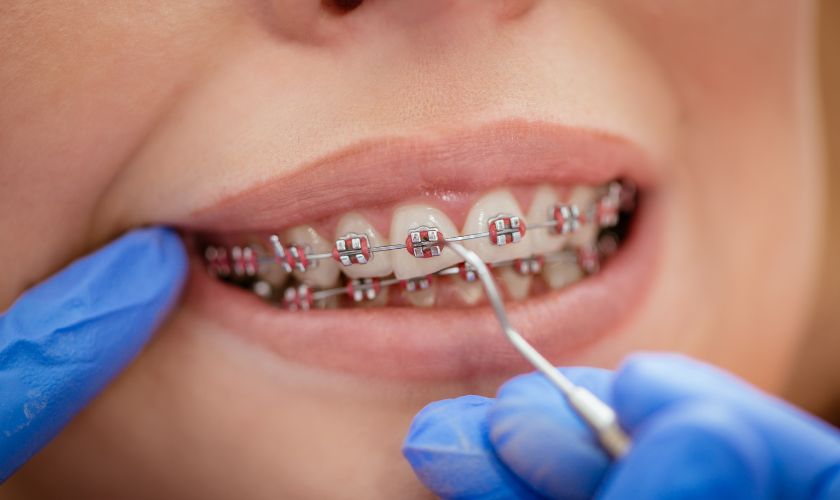 Maintaining-Oral-Hygiene-with-Braces-Essential-Tips-for-Brockport-Residents