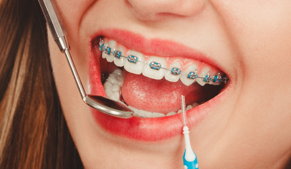 Close-up of patient with metal braces using interdental brush for oral hygiene maintenance.