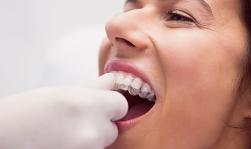 Aligners in Rochester