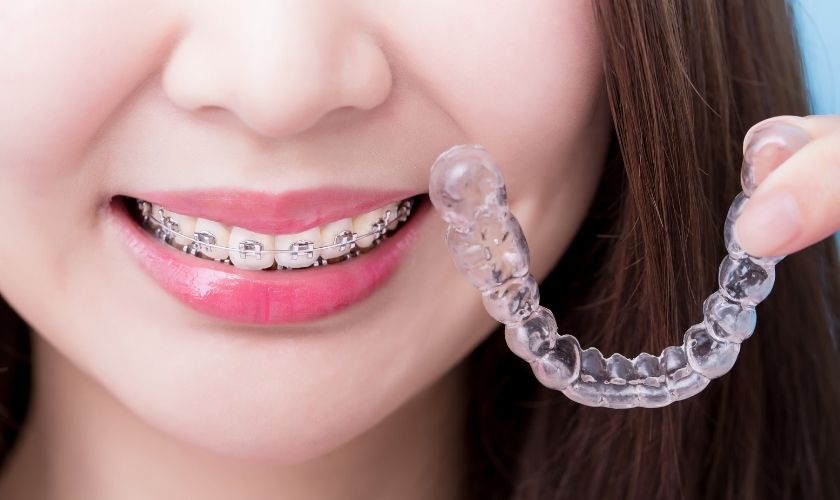 Orthodontic Treatment in Rochester and Brockport- Bateman Orthodontics
