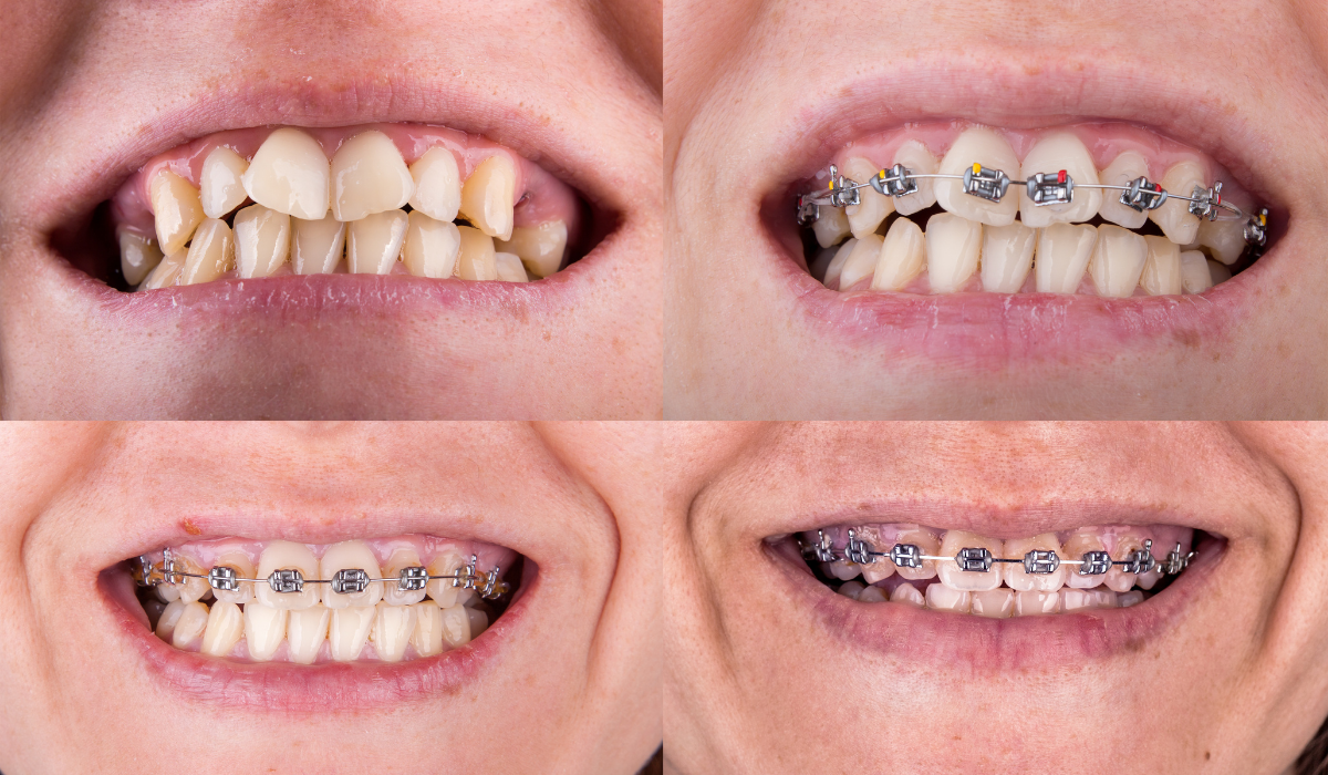 Before and after orthodontic treatment showing crooked teeth transformed to straight alignment with braces.
