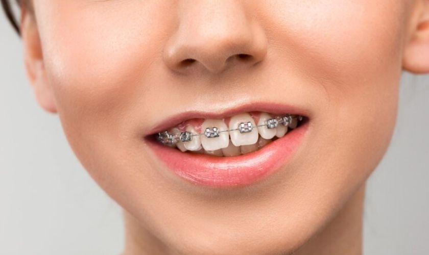 braces in Rochester