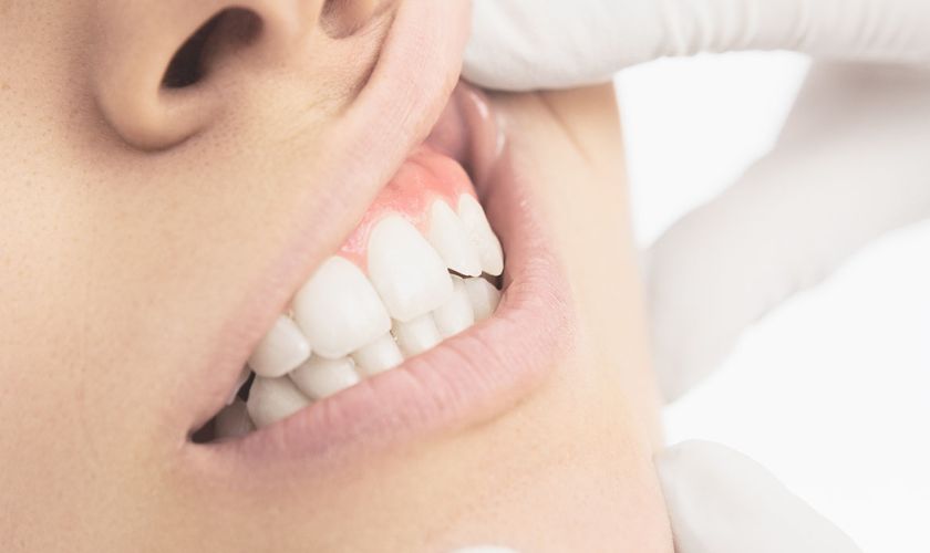 gum disease from clear aligners