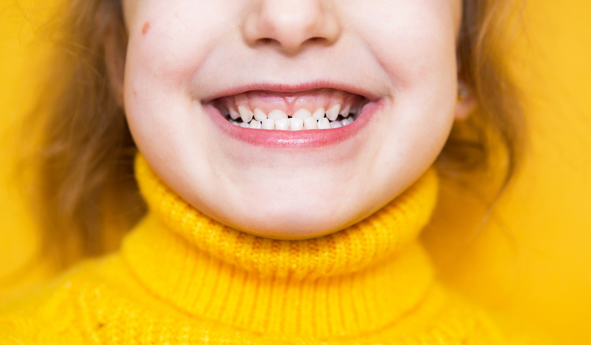 Child smiling with overbite, showing teeth that need orthodontic treatment.