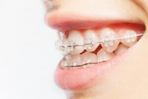ceramic braces