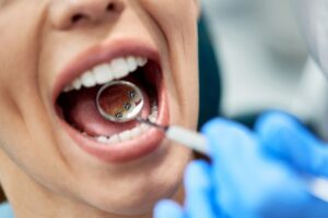lingual braces