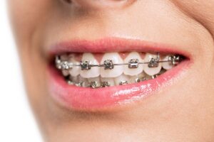 Traditional Metal Braces