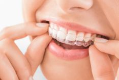 Invisalign Treatment