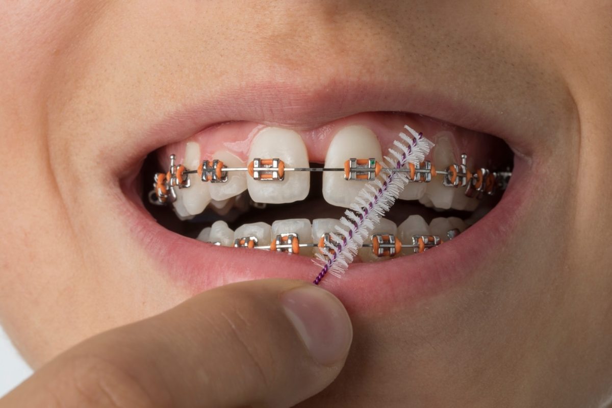 flossing with braces