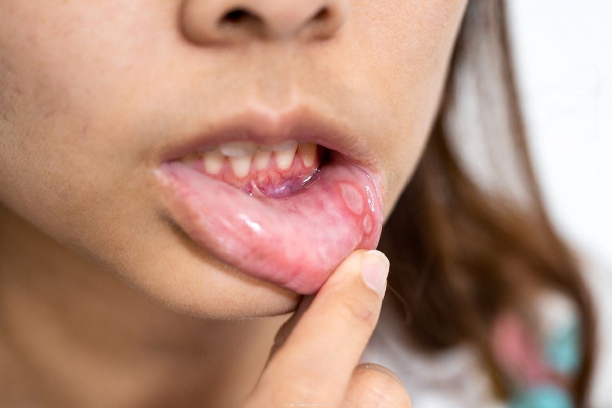 canker sores from braces