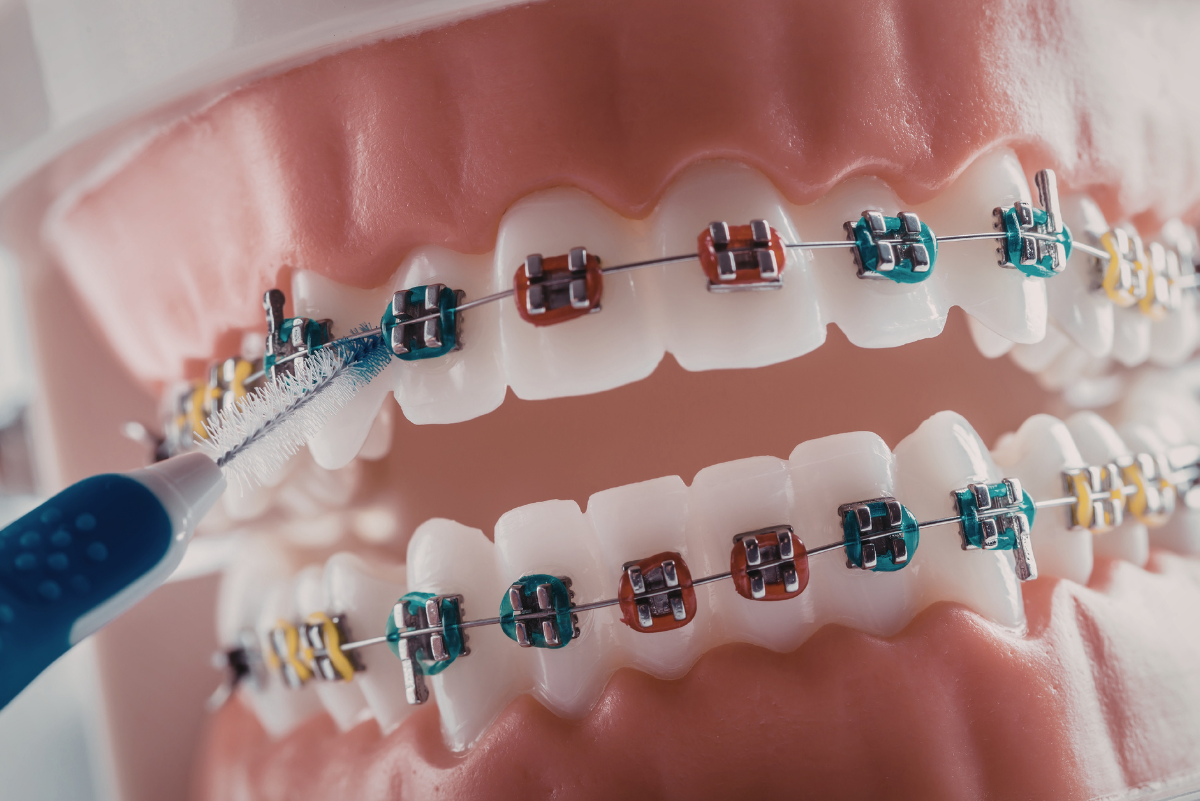 How Braces Affect Facial Appearance During And After Treatment