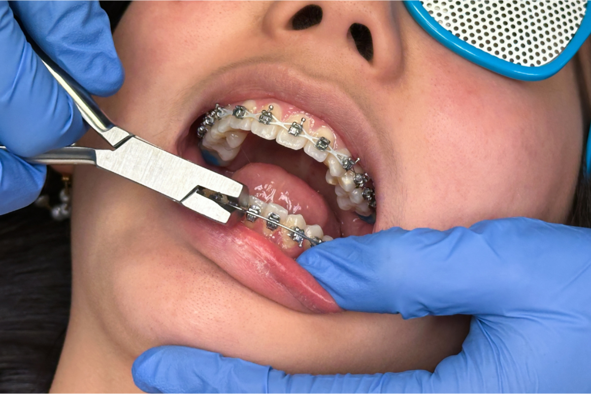 Braces vs Invisalign
