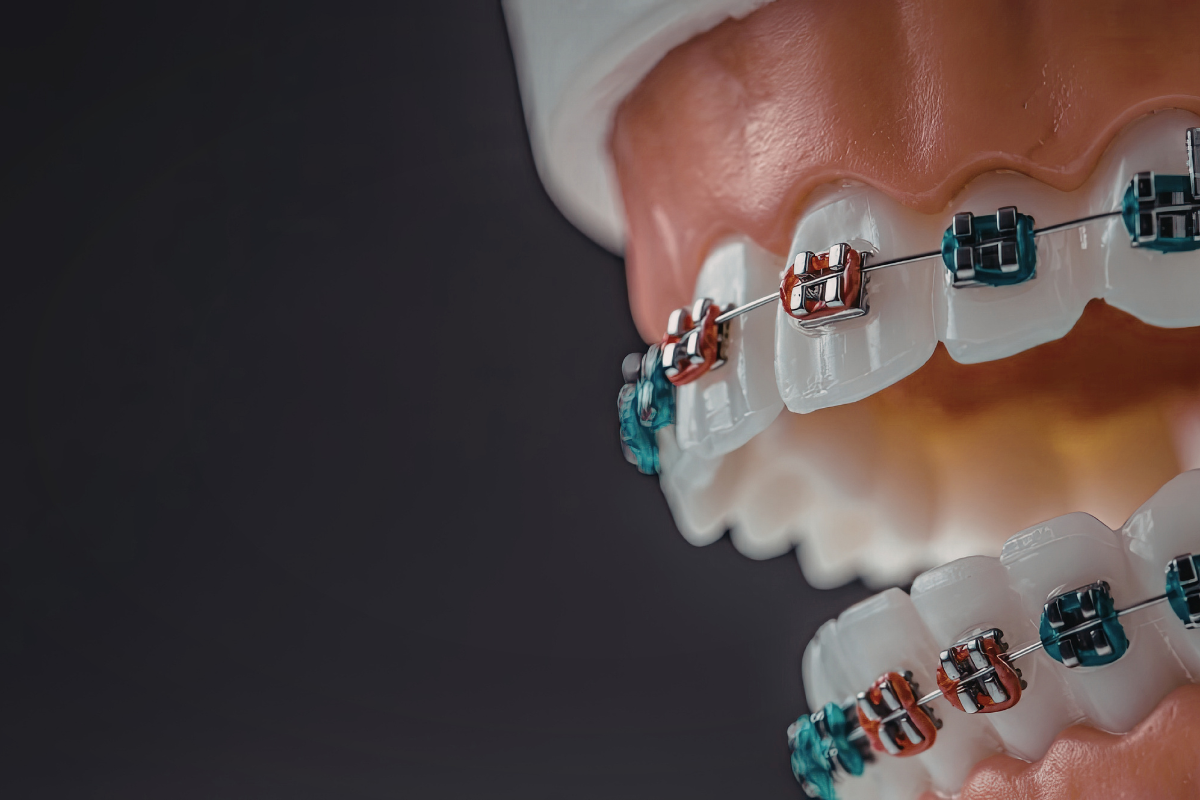Orthodontic Treatment for Seniors