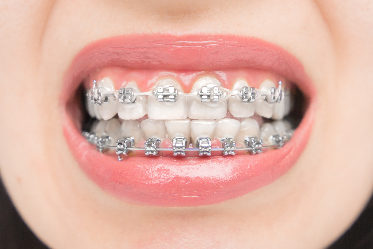 Different Types of Braces