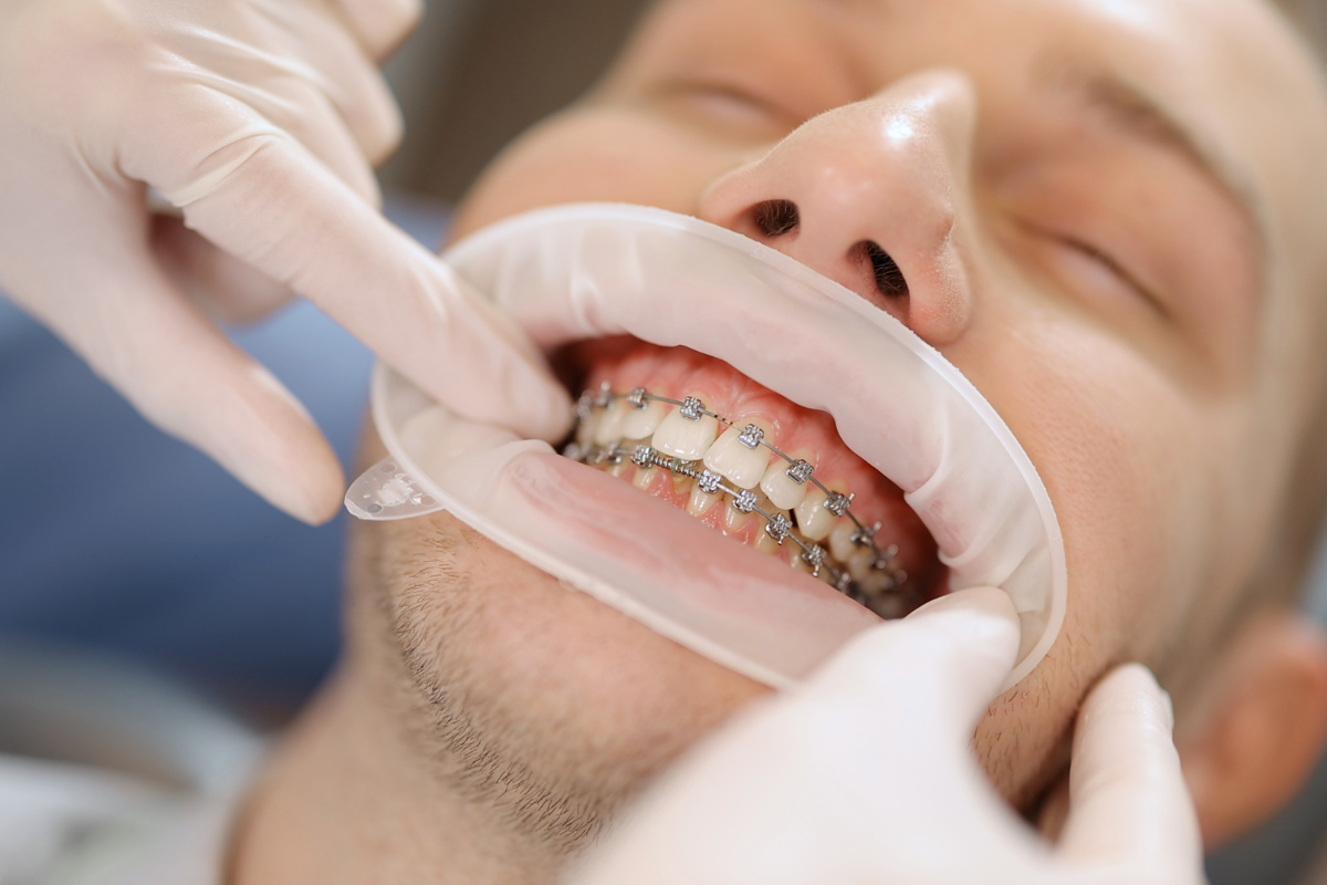Orthodontist examining patient's teeth with metal braces during dental checkup.