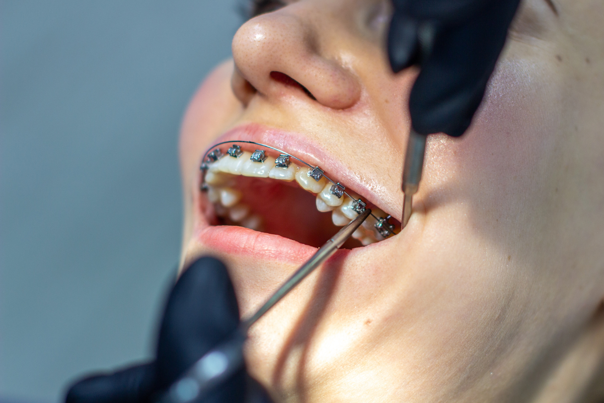 Teeth Keep Shifting Even Years After Braces