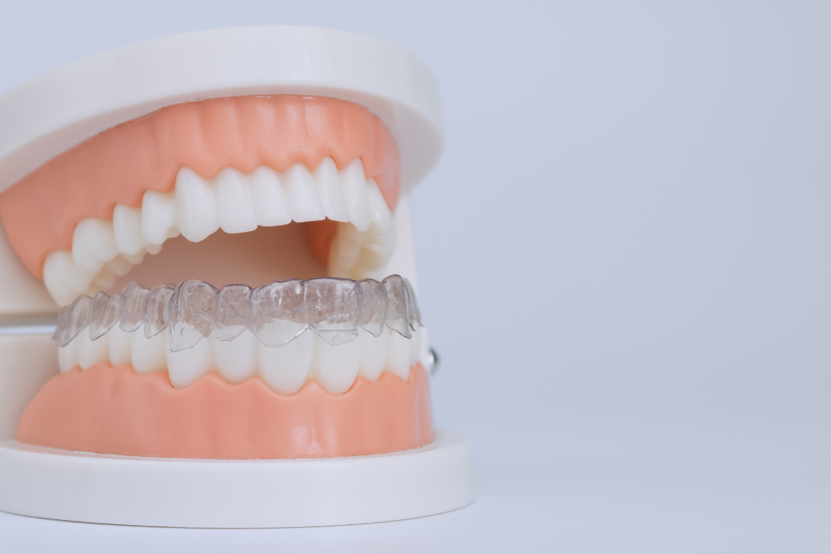 Can Remote Monitoring Be Part of Professionally Supervised Clear Aligner Treatment?
