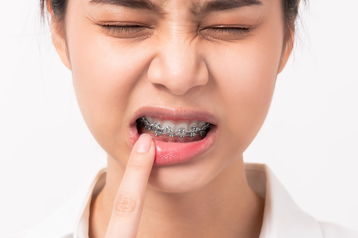 How Can You Relieve Braces Pain and Discomfort at Home?