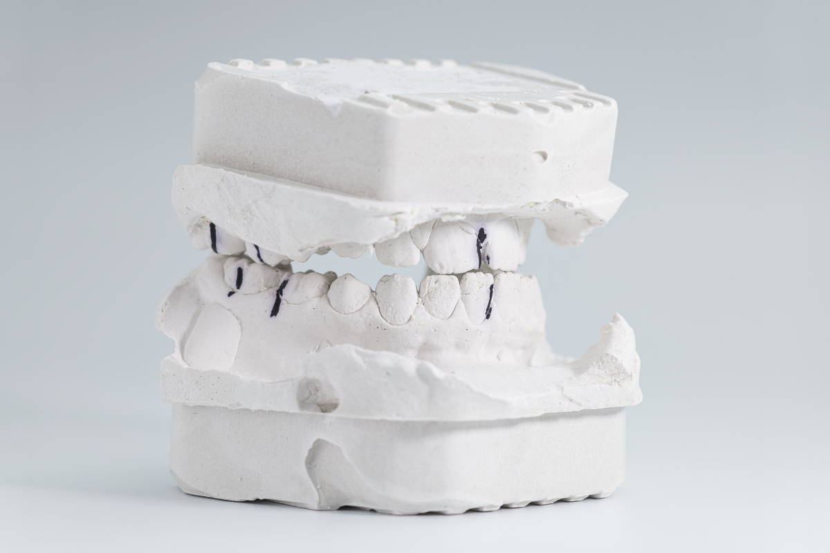Comprehensive Treatment for Patients With Multiple Bite and Alignment Problems