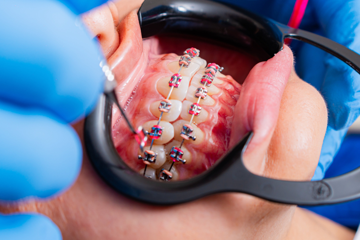 Getting Braces for the First Time_ What to Expect in the First Few Weeks