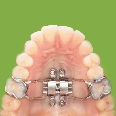 Orthodontic Treatment For Adults